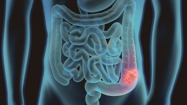 qFIT test helps prevent colorectal bowel cancer